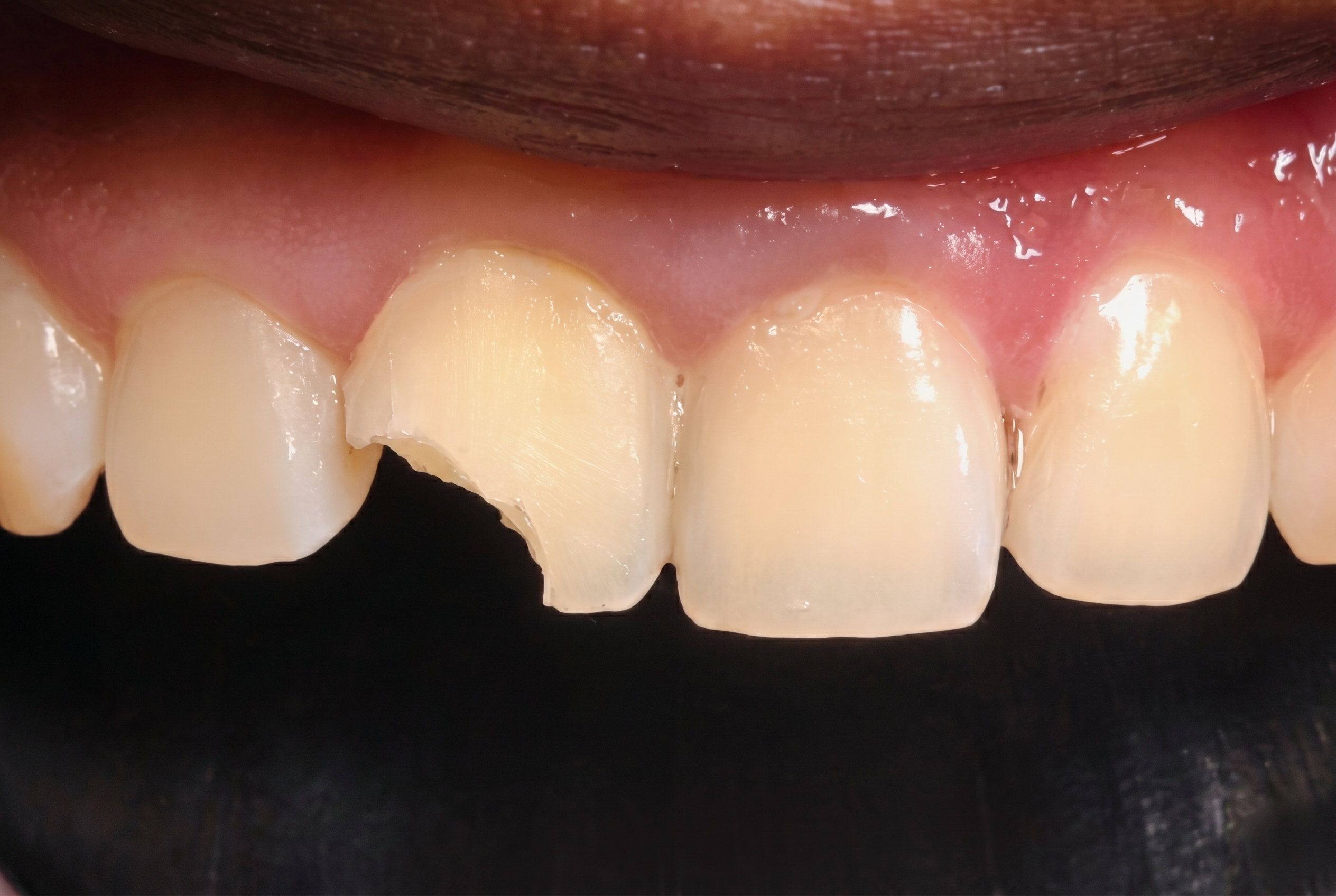 Dental Filling - Before